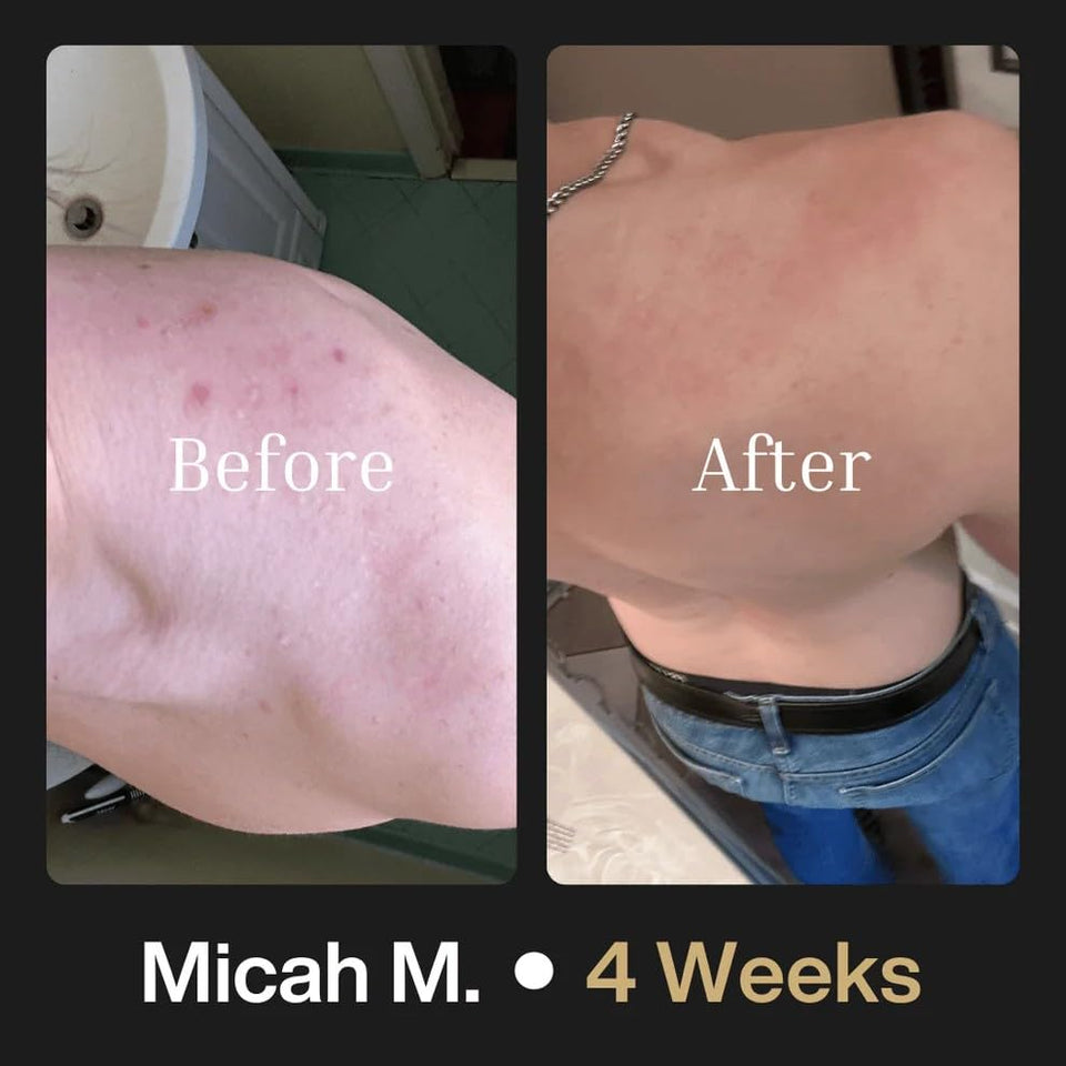 Shield Men's Acne Body Wash for Back, Chest & Shoulders - 4% Benzoyl Peroxide Body Wash, Clears Breakouts & Acne Scars – Unscented with Niacinamide, Glycolic Acid & Ceramides, 8.5 oz